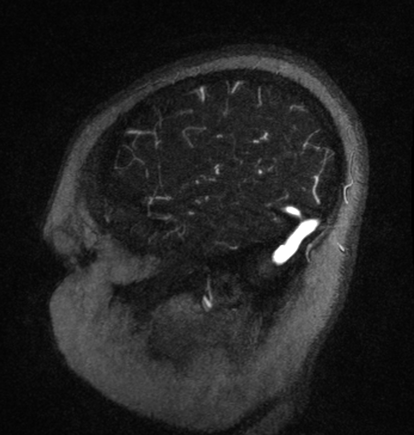 Normal brain MRI and venogram (Radiopaedia 39554-41862 Sagittal MRV 7).jpg