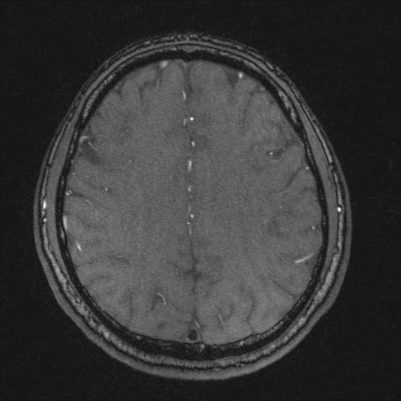 Normal brain MRI including MRA (Radiopaedia 48748-53763 Axial MRA 155).jpg