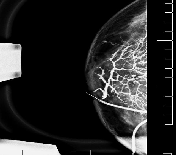 File:Normal breast ductogram (Radiopaedia 36440-37995 CC 1).JPG