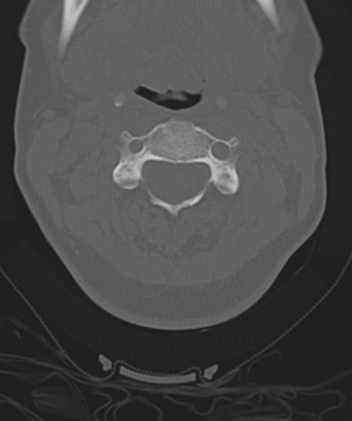 Normal cervical spine MRI (including Dixon) (Radiopaedia 42762-45926 Axial bone window 22).png