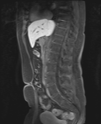 File:Normal hepatobiliary phase liver MRI (Radiopaedia 58968-66230 C 41).jpg