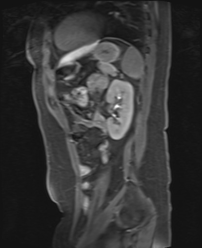 File:Normal hepatobiliary phase liver MRI (Radiopaedia 58968-66230 C 57).jpg