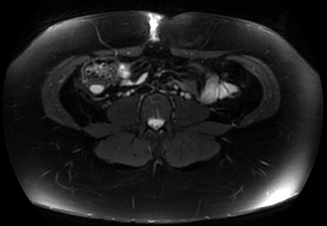File:Normal liver MRI with Gadolinium (Radiopaedia 58913-66163 Axial T2 fat sat 3).jpg