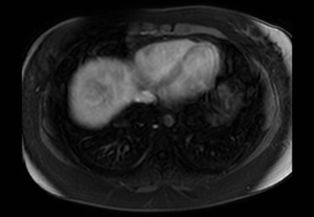 Normal liver MRI with Gadolinium (Radiopaedia 58913-66163 J 72).jpg