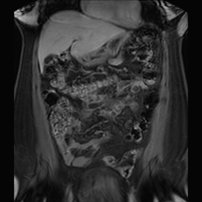 Normal liver MRI with Gadolinium (Radiopaedia 58913-66163 P 29).jpg
