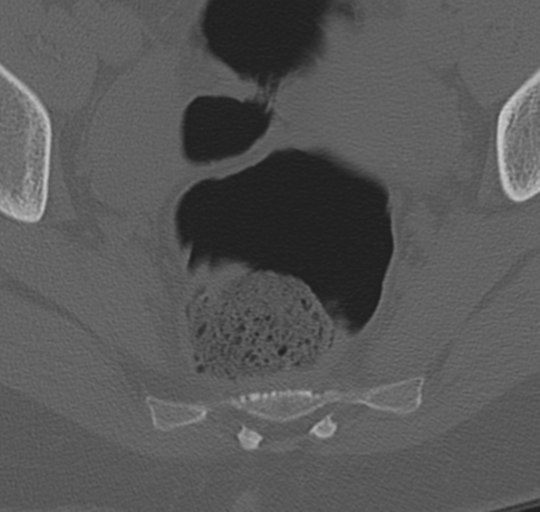 File:Normal lumbosacral CT (Radiopaedia 37923-39867 Axial bone window 103).png