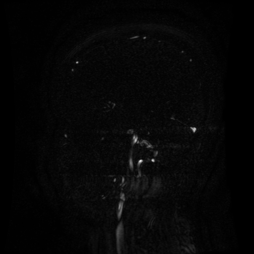 Normal noncontrast MR venography (Radiopaedia 87578-103957 A 119).jpg