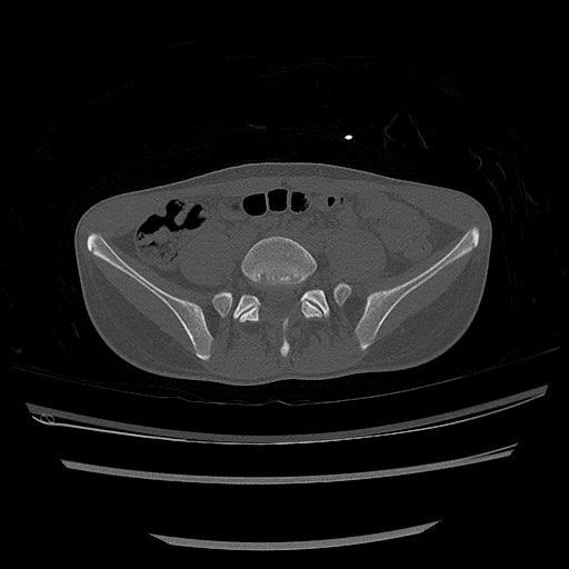 Normal pelvis CT (Radiopaedia 51471-57236 Axial bone window 15).jpg