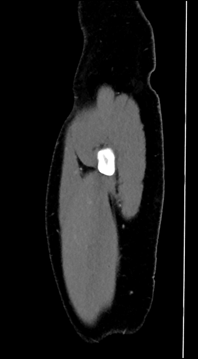 Normal pelvis CT angiogram (Radiopaedia 84966-100481 C 3).jpg