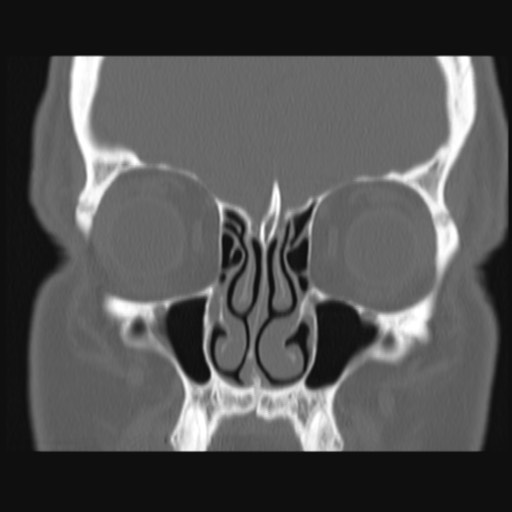 Normal sinus CT (annotated) (Radiopaedia 78917-91810 Coronal bone window 23).jpg