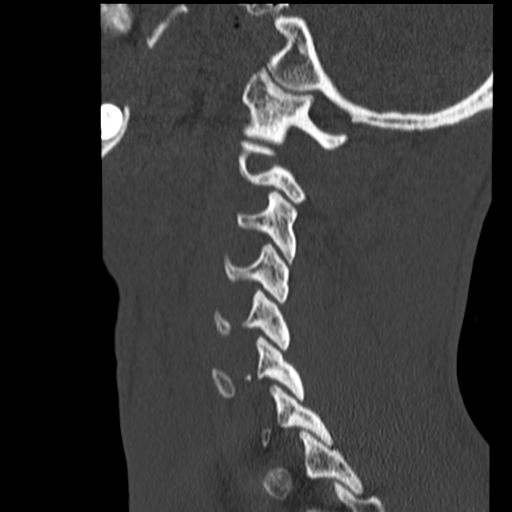 File:Normal trauma cervical spine (Radiopaedia 41017-43760 Sagittal bone window 36).png