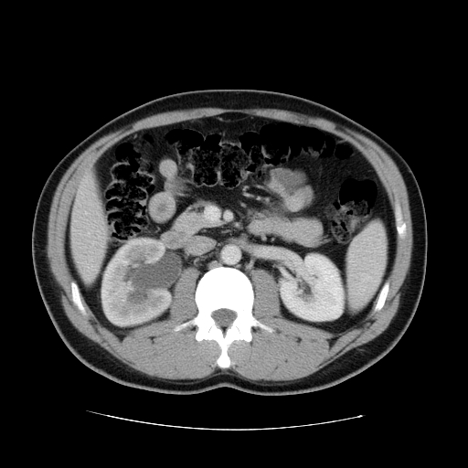 File:Obstructing ureteric calculus (Radiopaedia 18615-18514 B 23).jpg