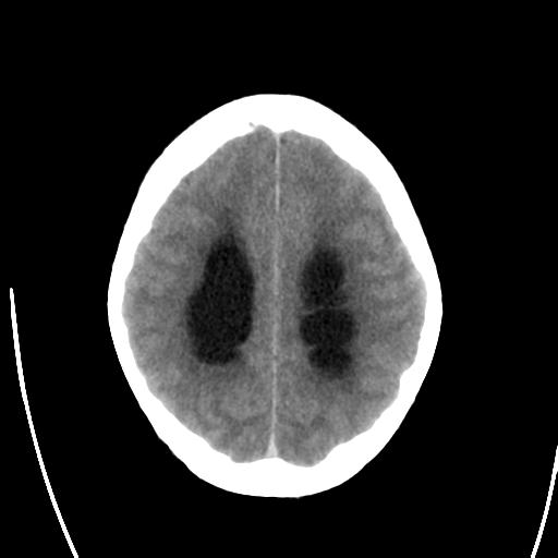 File:Obstructive hydrocephalus (Radiopaedia 30453-31119 Axial non-contrast 21).jpg