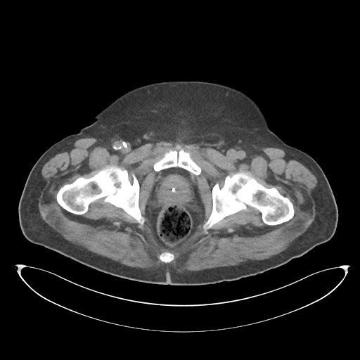 File:Obstructive pyelonephritis (Radiopaedia 46411-50844 Axial non-contrast 78).png