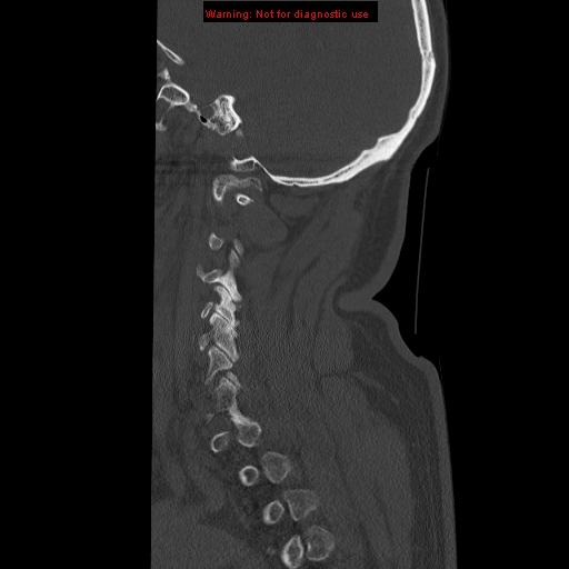 File:Occipital condyle fracture (Radiopaedia 18366-18208 Sagittal bone window 31).jpg