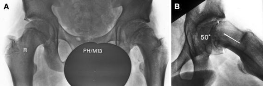 Slipped capital femoral epiphysis before surgery