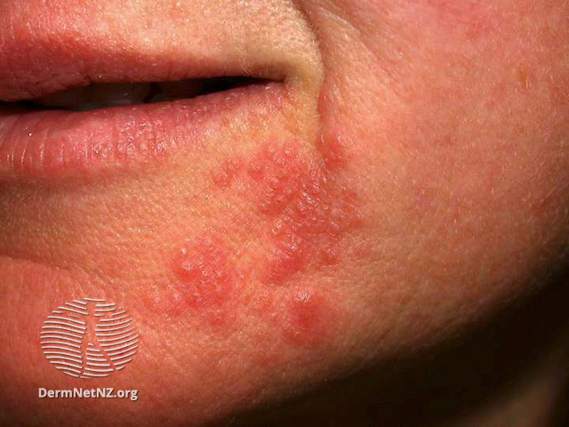 File:Perioral dermatitis (DermNet NZ acne-perioral-dermatitis-3424).jpg