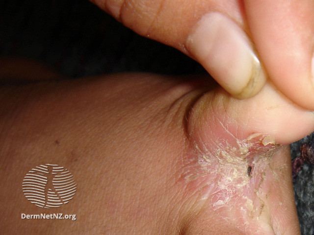 File:Psoriasis (DermNet NZ fungal-athfoot3).jpg