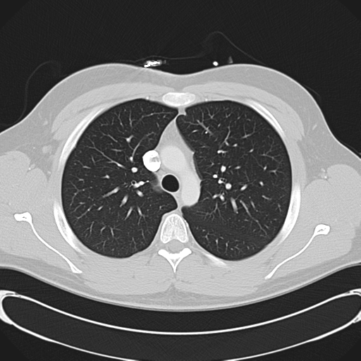 File:'Bovine' aortic arch (Radiopaedia 33554-34637 Axial lung window 20).png