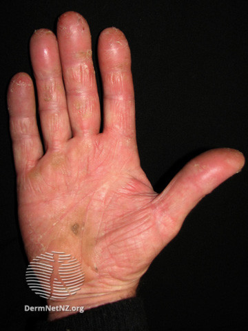 File:(DermNet NZ dermatitis-hand-dermatitis-2850).jpg