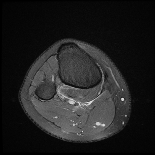File:ACL acute full thickness tear - deep lateral femoral sulcus sign (Radiopaedia 38594-40740 Axial PD fat sat 25).jpg