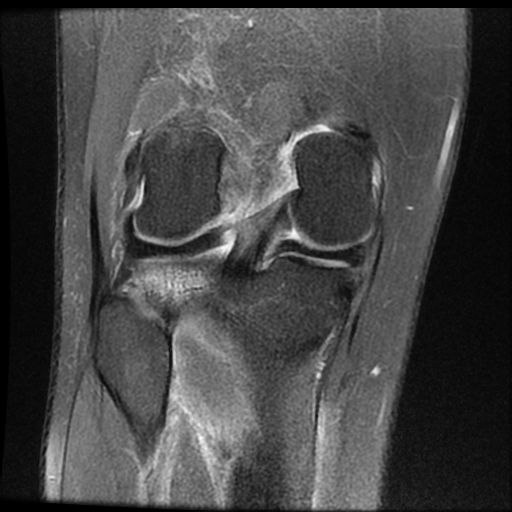 File:ACL acute full thickness tear - deep lateral femoral sulcus sign (Radiopaedia 38594-40740 Coronal PD fat sat 15).jpg