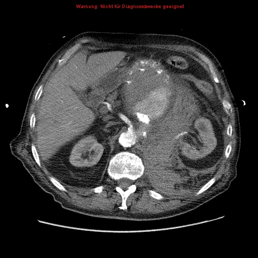 Abdominal aortic aneurysm- extremely large, ruptured (Radiopaedia 19882-19921 Axial C+ arterial phase 20).jpg