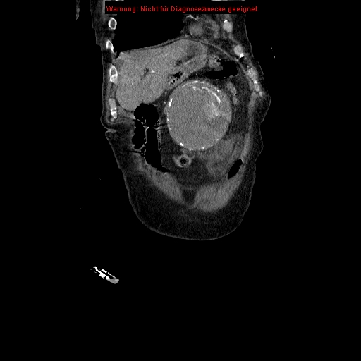 Abdominal aortic aneurysm- extremely large, ruptured (Radiopaedia 19882-19921 Coronal C+ arterial phase 19).jpg
