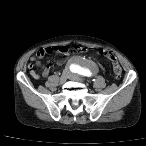 Abdominal aortic aneurysm (Radiopaedia 29248-29660 Axial C+ arterial phase 62).jpg