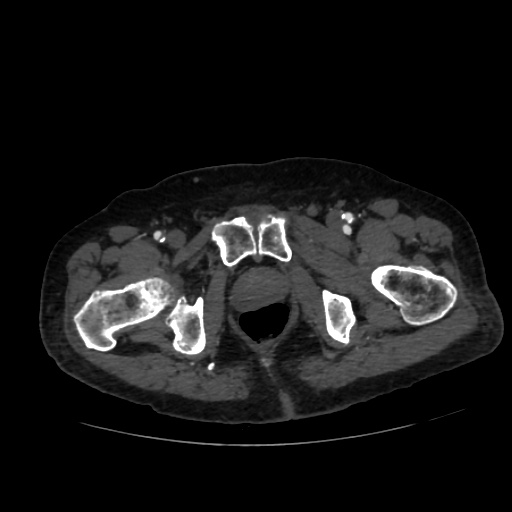 File:Abdominal aortic aneurysm (Radiopaedia 57318-64259 Axial C+ arterial phase 77).jpg