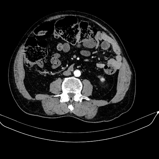 File:Abdominal aortic aneurysm (Radiopaedia 67117-76452 Axial C+ arterial phase 75).jpg
