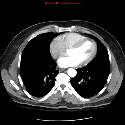 File:Abdominal aortic aneurysm (Radiopaedia 8190-9038 Axial C+ arterial phase 1).jpg