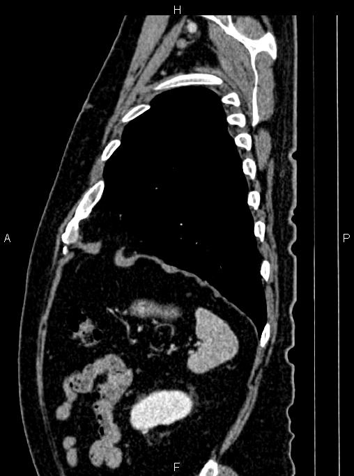 Abdominal aortic aneurysm (Radiopaedia 83094-97462 Sagittal renal cortical phase 101).jpg