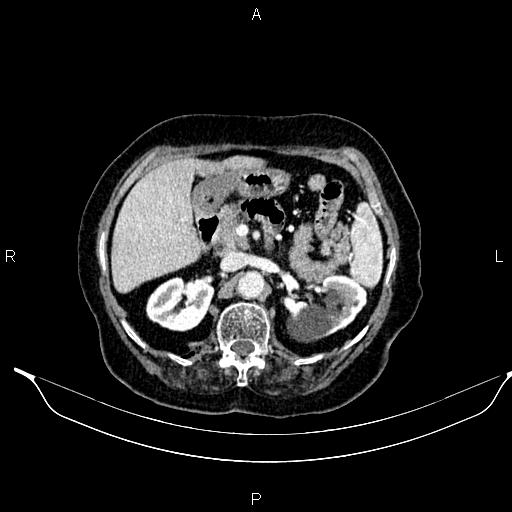 File:Abdominal aortic aneurysm (Radiopaedia 85063-100606 Axial C+ portal venous phase 35).jpg