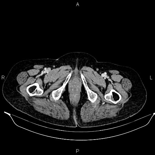 File:Abdominal aortic aneurysm (Radiopaedia 85063-100606 Axial C+ portal venous phase 69).jpg
