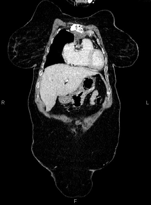 Abdominal aortic aneurysm (Radiopaedia 85063-100606 Coronal C+ arterial phase 5).jpg