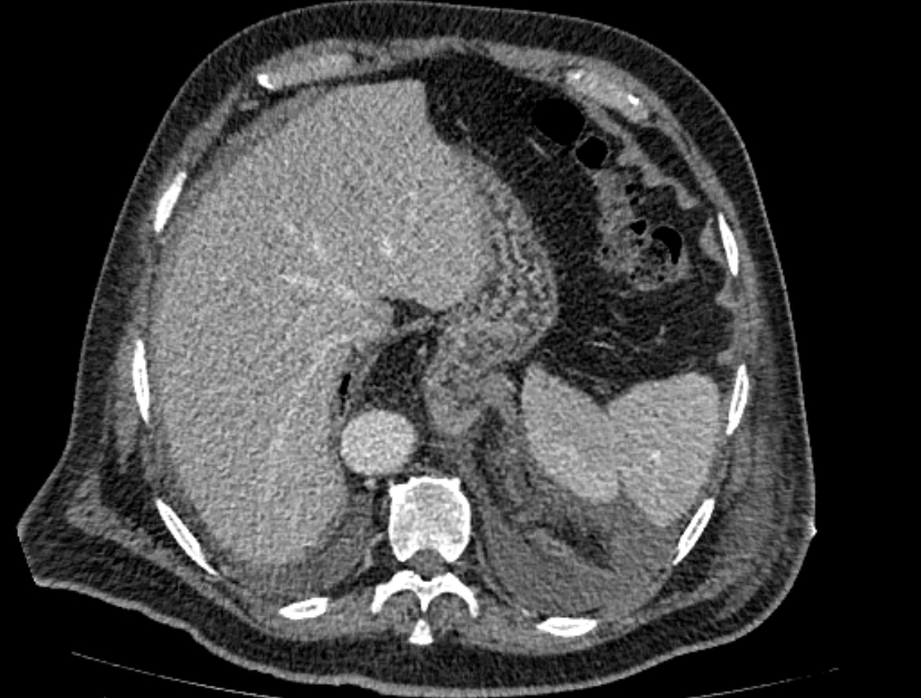 Abdominal aortic aneurysm rupture (Radiopaedia 54179-60362 Axial C+ portal venous phase 33).jpg