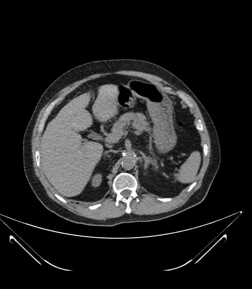Abdominal aortic aneurysm with thrombus fissuration (Radiopaedia 46218-50618 Axial non-contrast 14).jpg