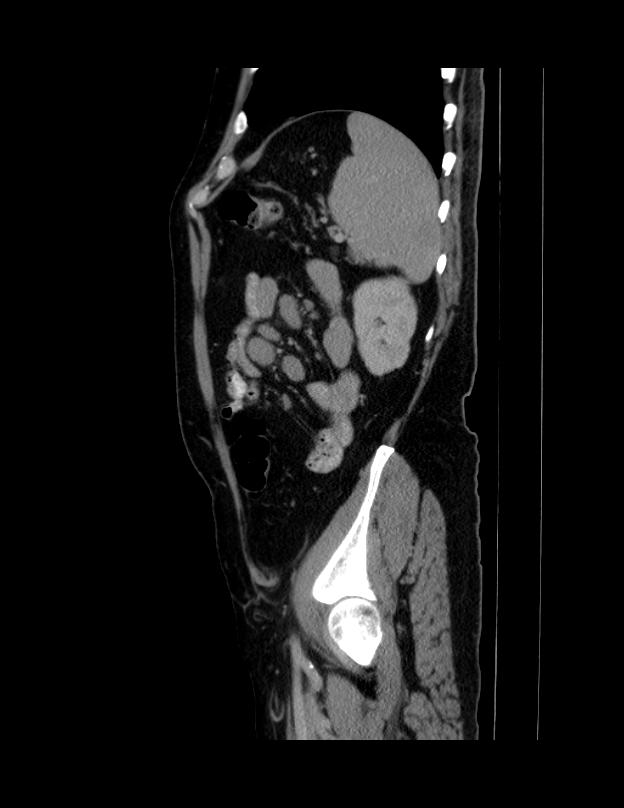 Abdominal lymphoma - with sandwich sign (Radiopaedia 53486-59492 Sagittal C+ portal venous phase 15).jpg