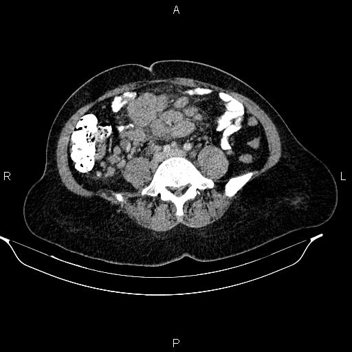File:Abdominal lymphoma with sandwich sign (Radiopaedia 84378-99704 Axial C+ portal venous phase 38).jpg