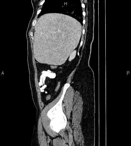 File:Abdominal lymphoma with sandwich sign (Radiopaedia 84378-99704 Sagittal C+ portal venous phase 77).jpg