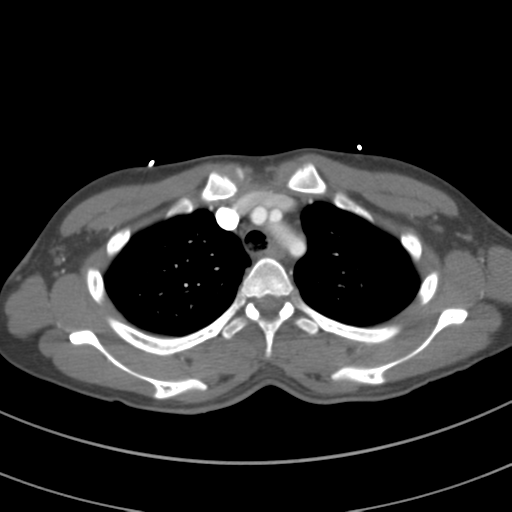 File:Abdominal multi-trauma - devascularised kidney and liver, spleen and pancreatic lacerations (Radiopaedia 34984-36486 Axial C+ arterial phase 22).png