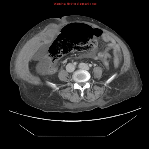 File:Abdominal wall hematoma (Radiopaedia 9427-10112 Axial C+ portal venous phase 68).jpg