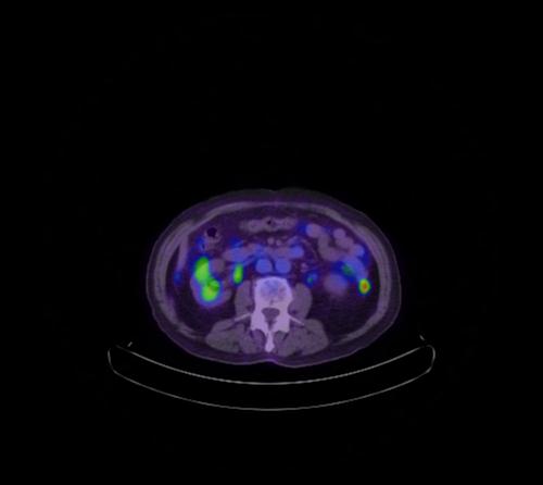 Abdominal wall metastasis from colorectal carcinoma (Radiopaedia 31016-31719 Axial 64).jpg