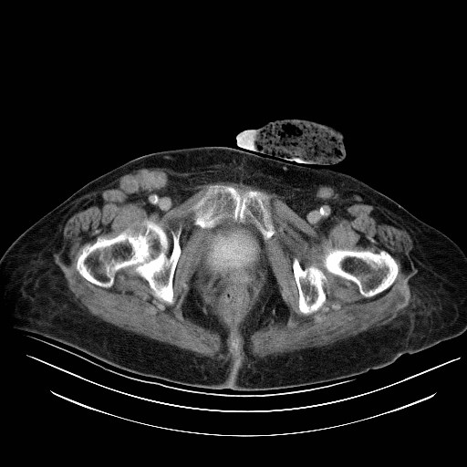 File:Abdominal wall recurrence after colorectal resection for cancer (Radiopaedia 23444-23523 Axial C+ portal venous phase 40).jpg