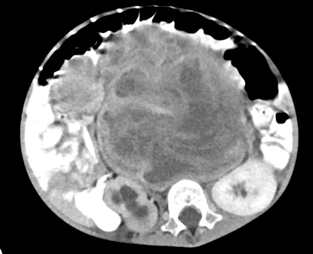 Abdominopelvic rhabdomyosarcoma (Radiopaedia 78356-90984 Axial C+ portal venous phase 91).jpg