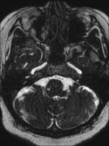 Abducens nerve palsy (Radiopaedia 57084-63976 Axial T2 ciss 3d 17).jpg