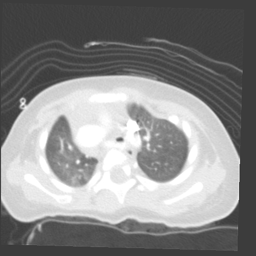 File:Aberrant left pulmonary artery (pulmonary sling) (Radiopaedia 42323-45435 Axial lung window 11).jpg
