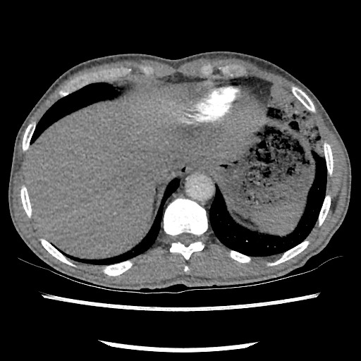 Accessory left horizontal fissure with lingular pneumonia (Radiopaedia 53763-59843 Axial C+ CTPA 77).jpg