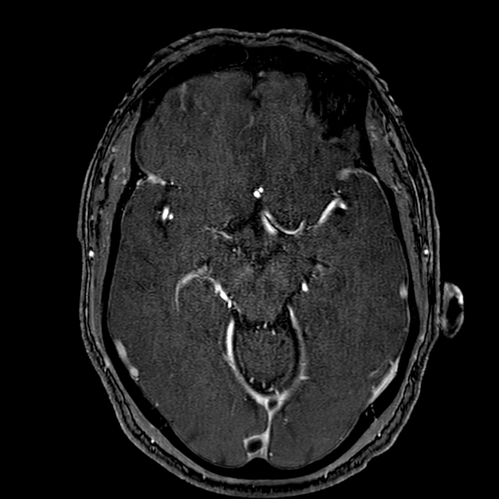 Accessory middle cerebral artery (Radiopaedia 73114-83828 Axial MRA 79).jpg